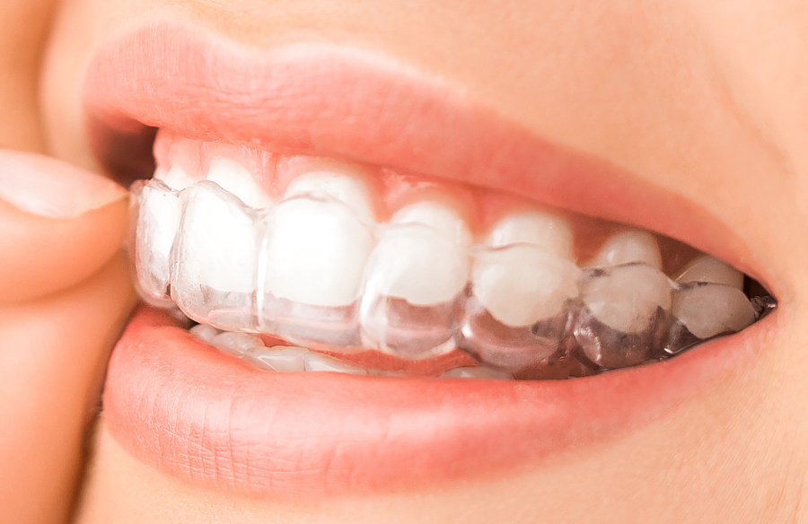 woman holding invisalign clear aligners