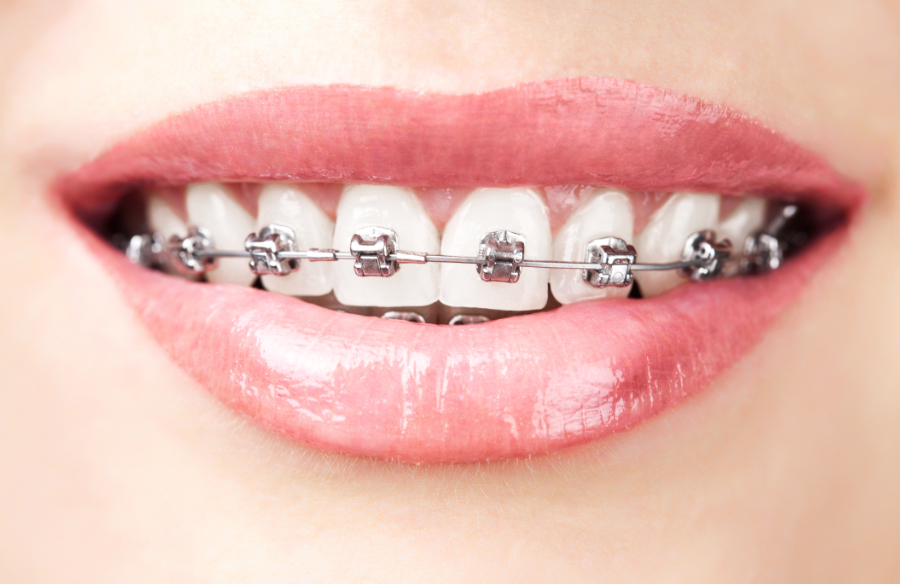 patient wearing metal braces