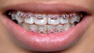 Braces Icon Orthodontics Surprise Glendale AZ