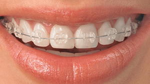 Ceramic Braces Icon Orthodontics Surprise Glendale AZ
