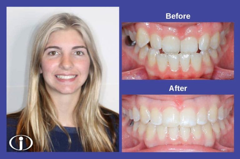 Smile Gallery -Before & Afters - Icon Orthodontics