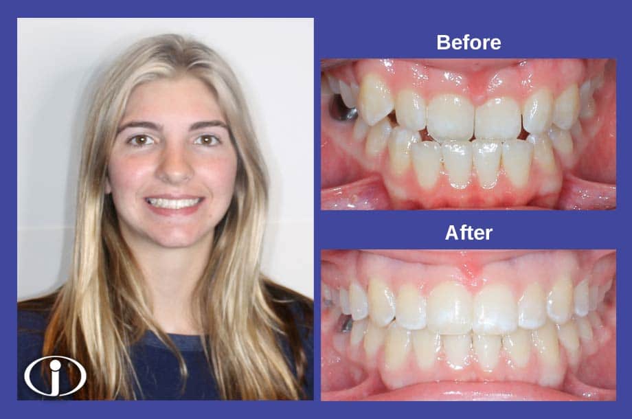 Before and After Smile Icon Orthodontics Surprise Glendale AZ