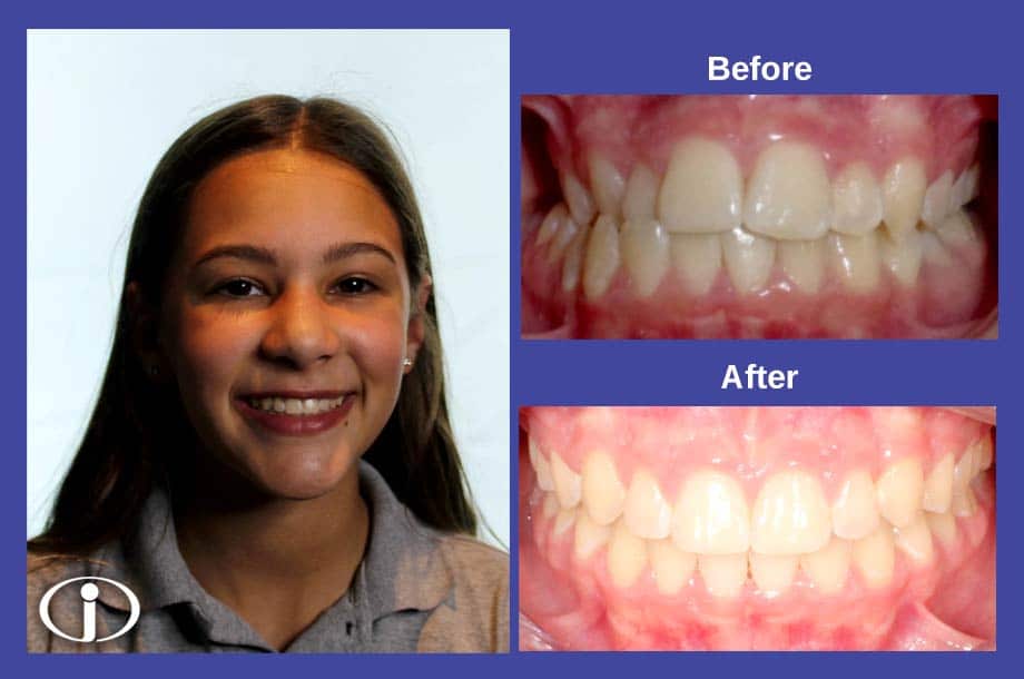 Before and After Icon Orthodontics Surprise Glendale AZ