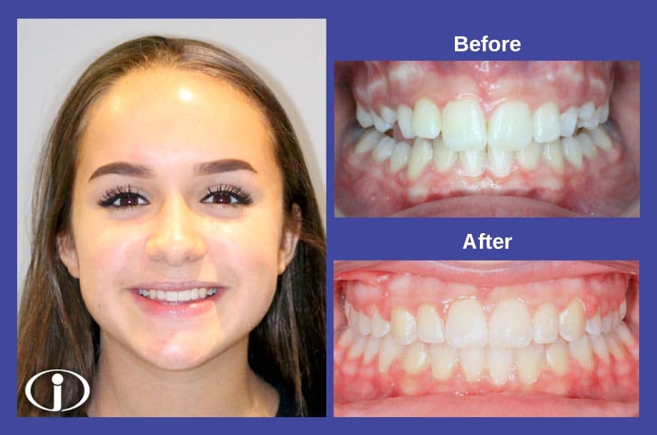 Before Smile and After Smile Icon Orthodontics Surprise Glendale AZ
