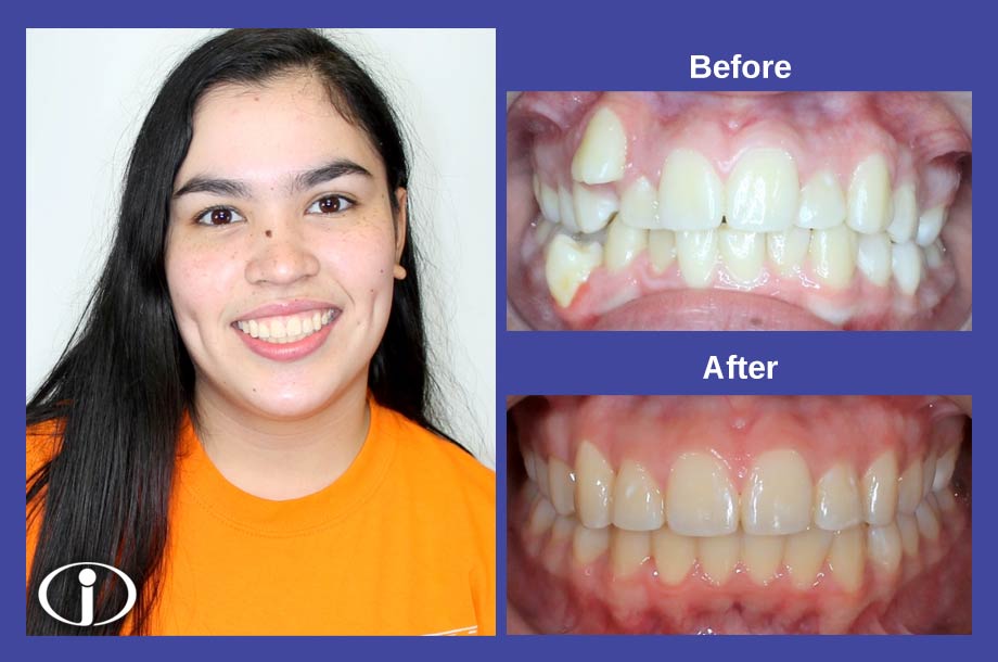 Before and After Pictures Icon Orthodontics Surprise Glendale AZ