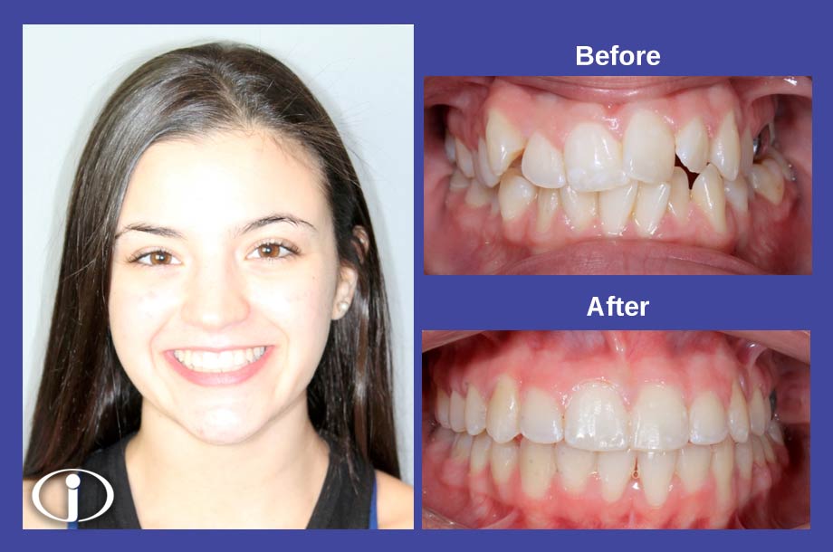 Orthodontic Results Icon Orthodontics Surprise Glendale AZ