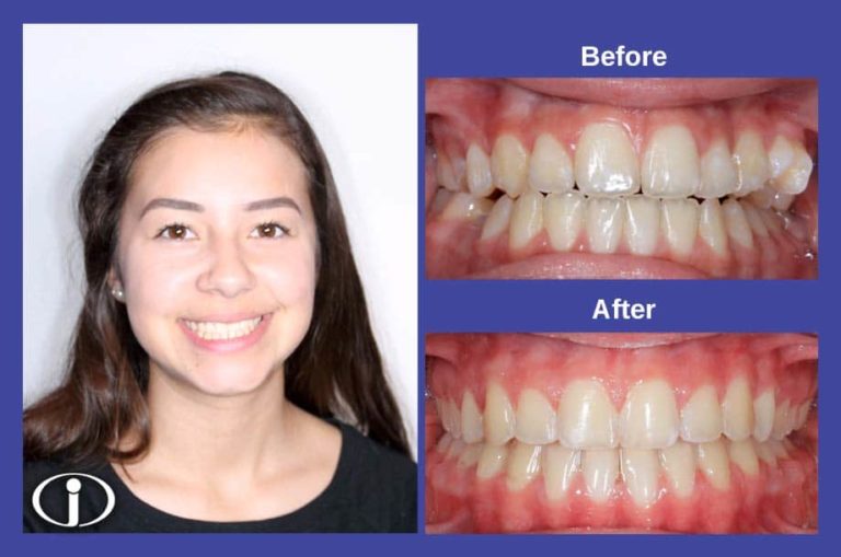 Smile Gallery -Before & Afters - Icon Orthodontics