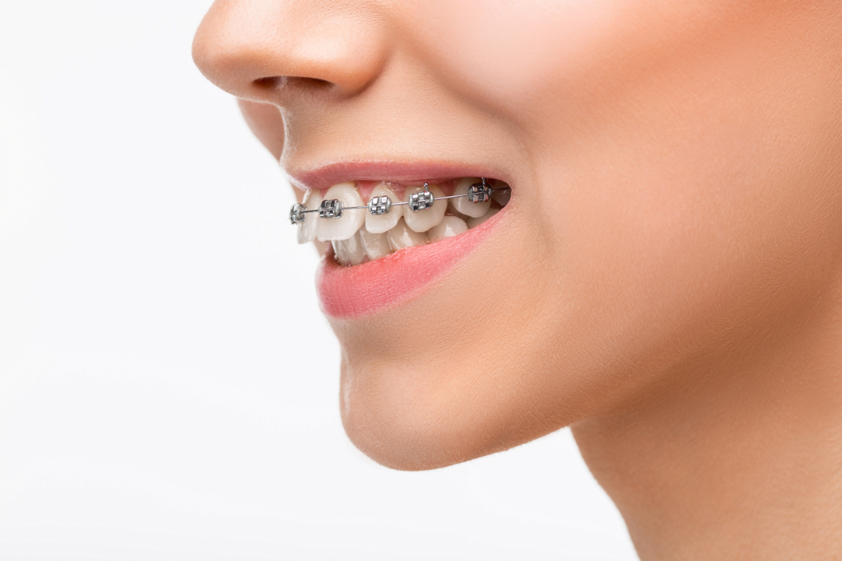 What Causes a Gummy Smile and How Can Orthodontic Treatment Help?