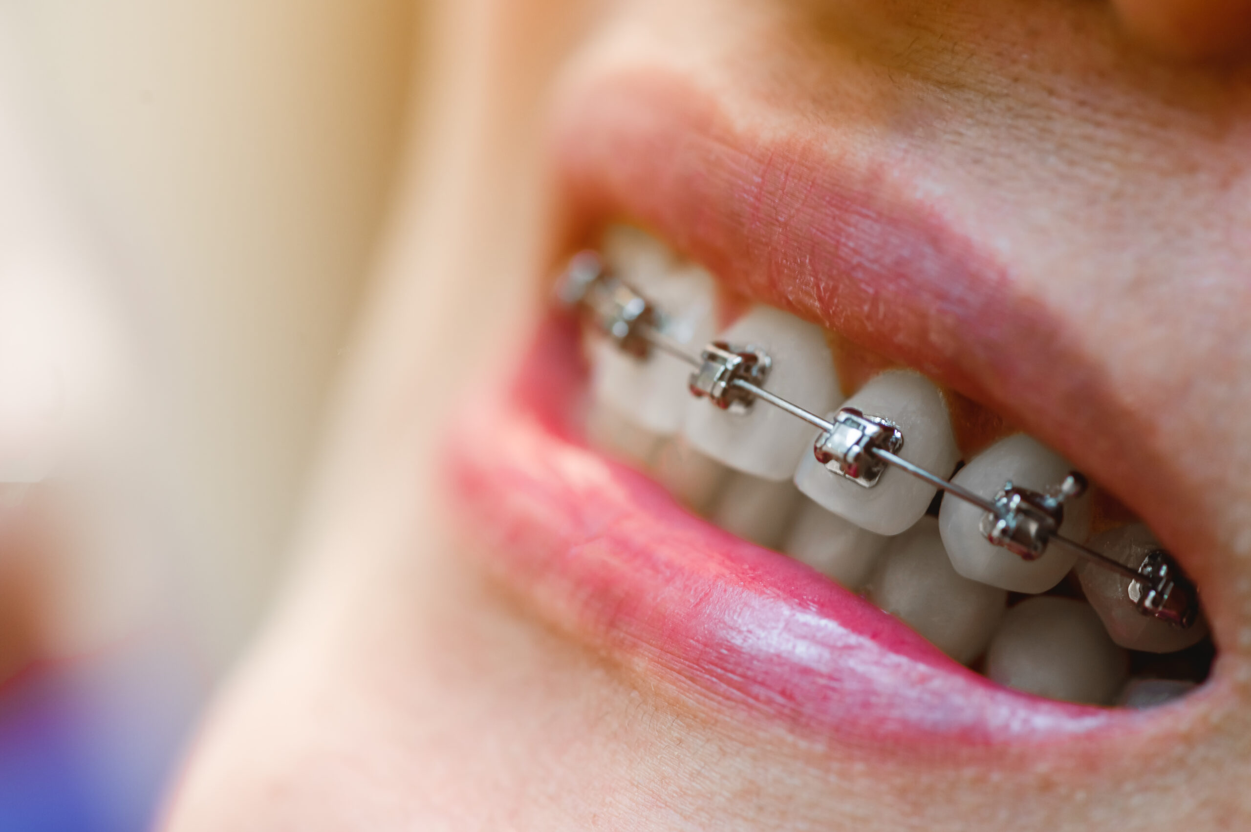 Close-up of a person's mouth displaying Damon Braces with metal brackets and clear ceramic options, highlighting orthodontic treatment for a confident smile.
