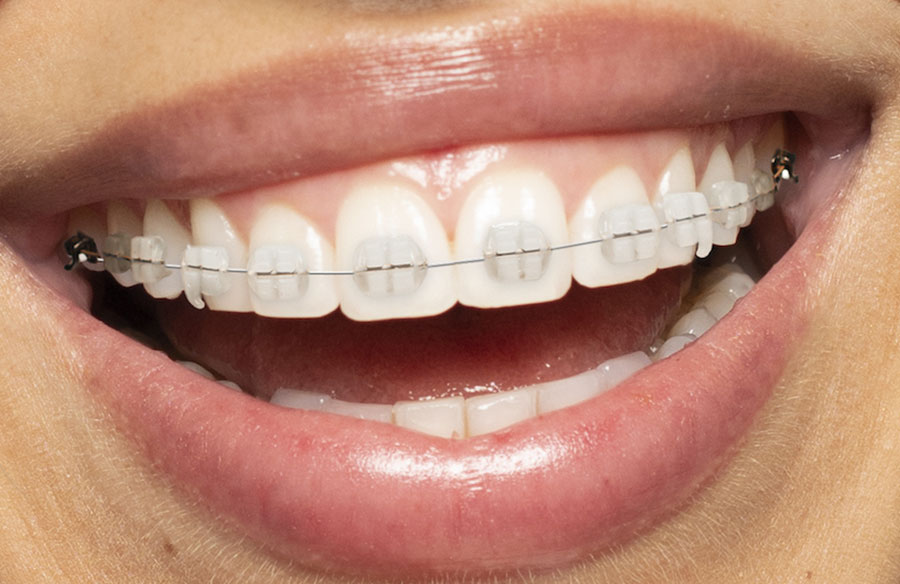 patient wearing clear braces