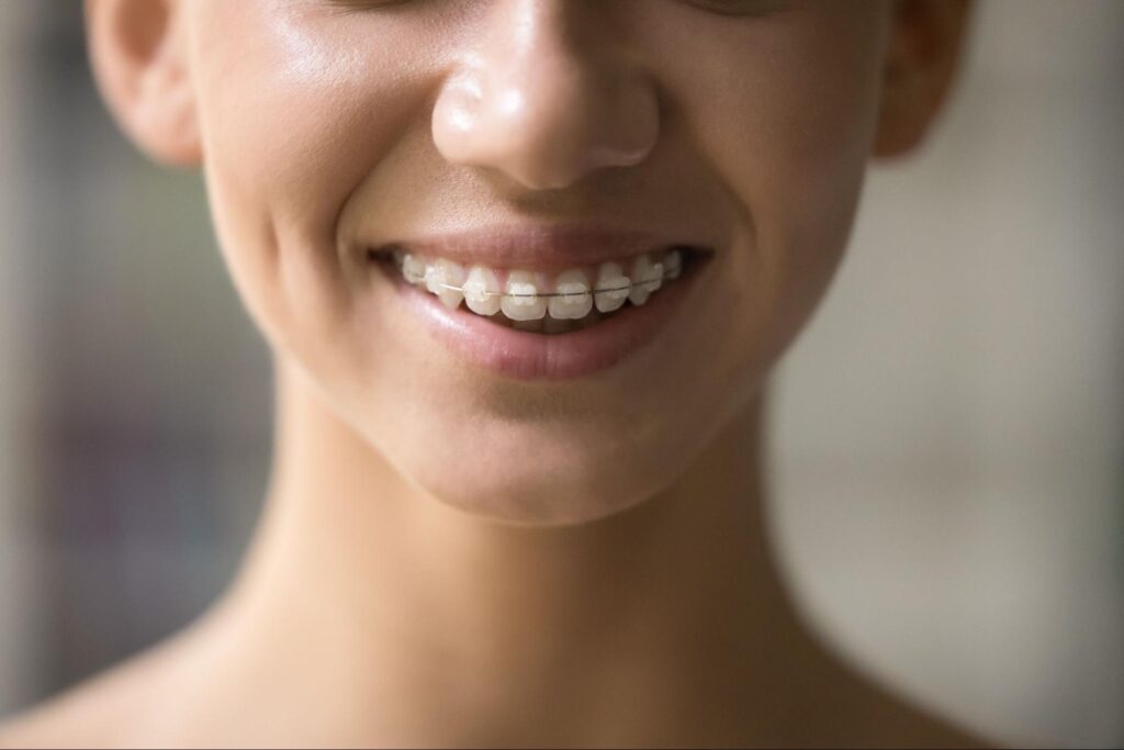 Should I Choose Braces or Clear Aligners?