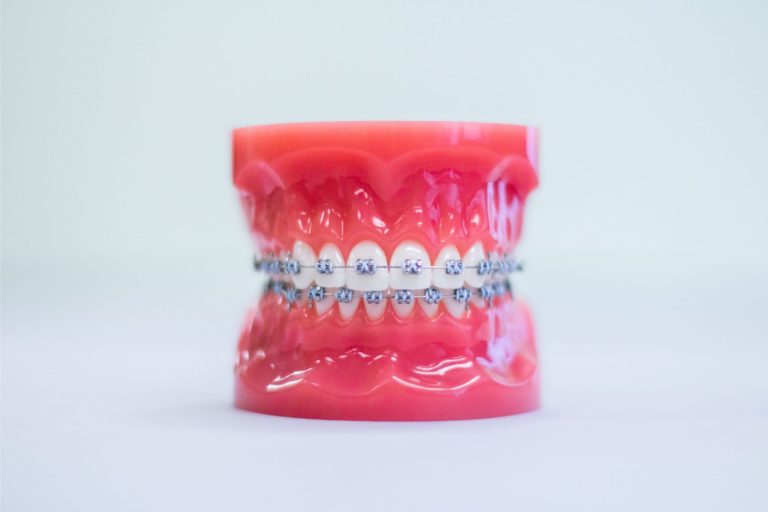 Surprise Orthodontics metal braces